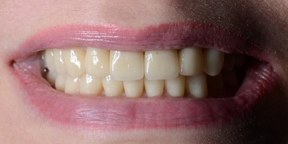 Тотальная реконструкция улыбки с протезированием на имплантах безметалловыми короноками и винирами - фото №7