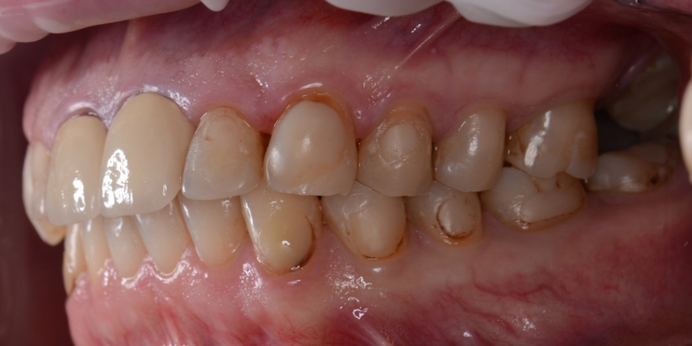 Тотальная реконструкция улыбки с протезированием на имплантах безметалловыми короноками и винирами - фото №4
