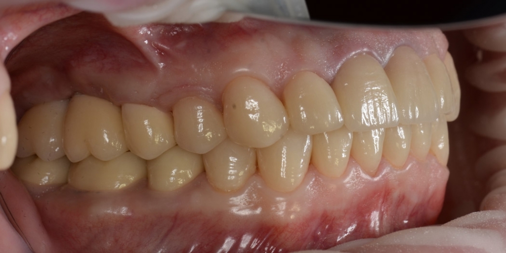 Тотальная реконструкция улыбки с протезированием на имплантах безметалловыми короноками и винирами - фото №5