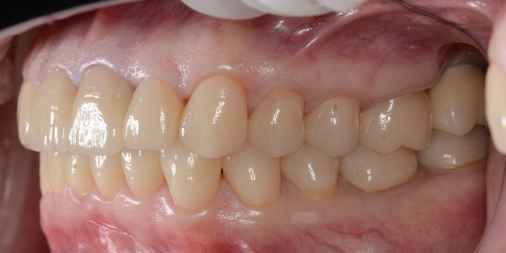 Тотальная реконструкция улыбки с протезированием на имплантах безметалловыми короноками и винирами - фото №6