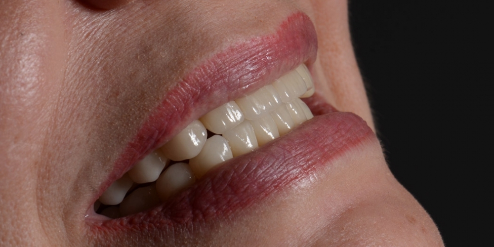 Тотальная реконструкция улыбки с протезированием на имплантах безметалловыми короноками и винирами - фото №2