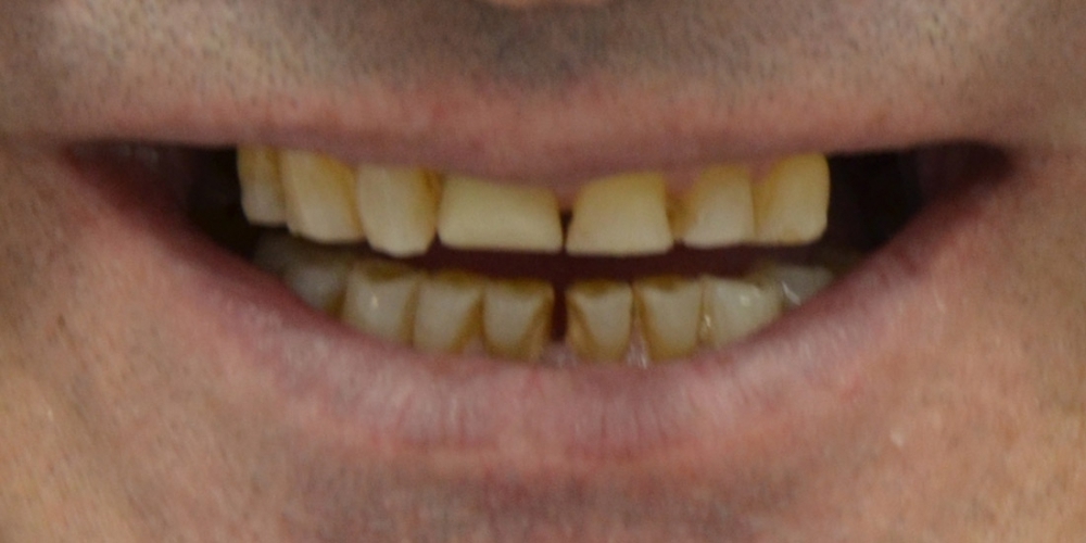 Тотальная реконструкция улыбки и протезирование керамическими коронками - фото №1