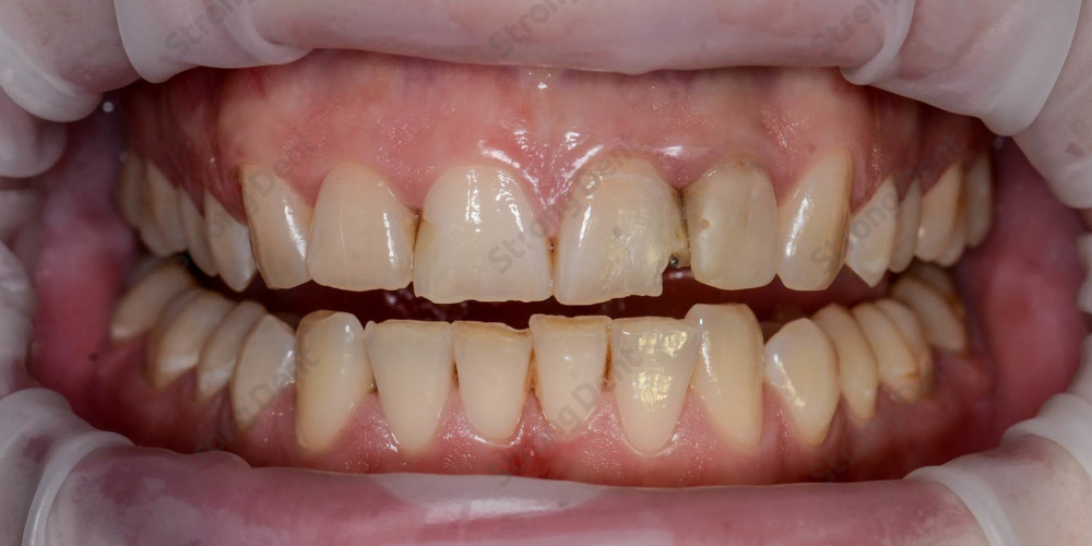 Результат установки высокоэстетичных виниров на передние зубы - фото №1