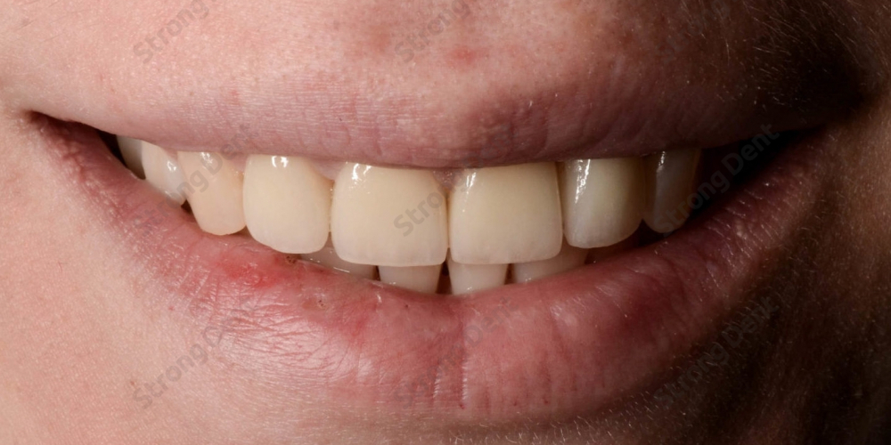 Результат установки высокоэстетичных виниров на передние зубы - фото №2