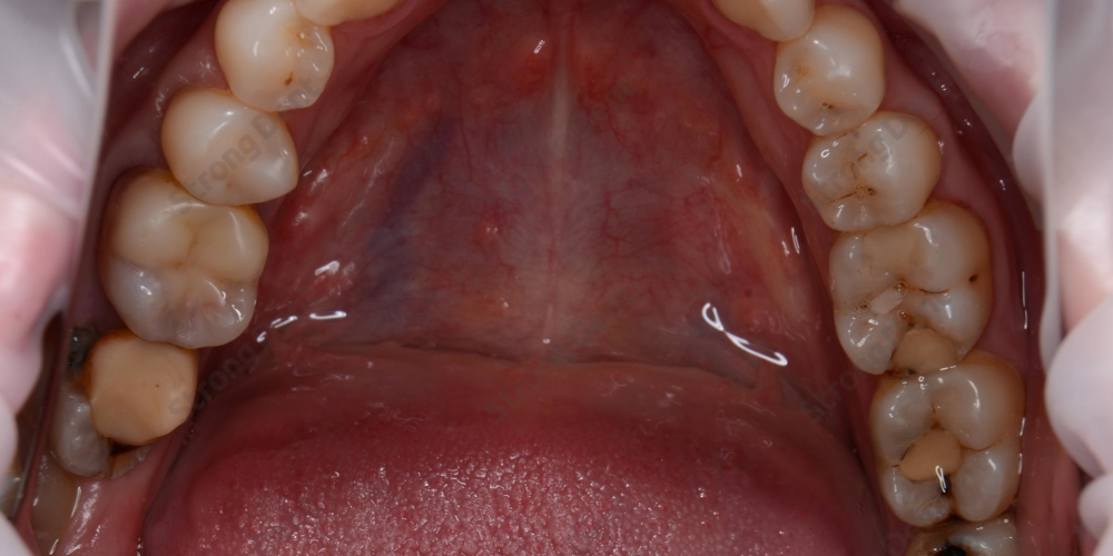 Протезирование зубов безметалловыми коронками - фото №1