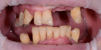 Имплантация при полной потере зубов, фото до и после - фото №1