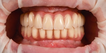 Имплантация при полной потере зубов, фото до и после - фото №2
