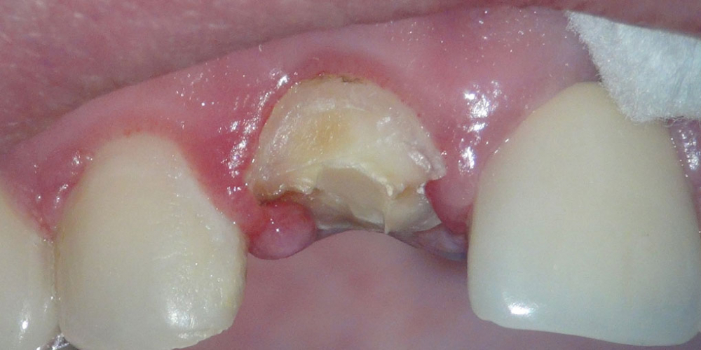 Жалоба на разрушение переднего зуба, подготовка к протезированию - фото №1