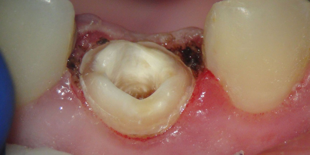 Жалоба на разрушение переднего зуба, подготовка к протезированию - фото №5