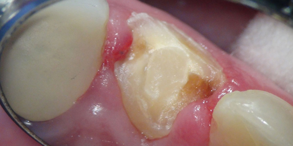 Жалоба на разрушение переднего зуба, подготовка к протезированию - фото №3