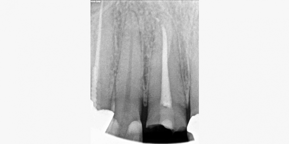 Жалоба на разрушение переднего зуба, подготовка к протезированию - фото №2