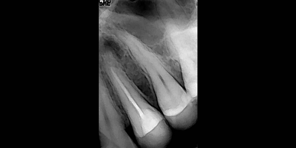 Лечение кисты зуба за одну неделю - фото №1