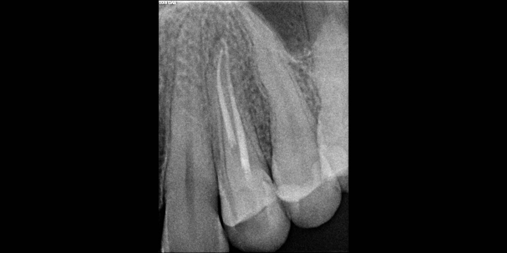 Лечение кисты зуба за одну неделю - фото №2