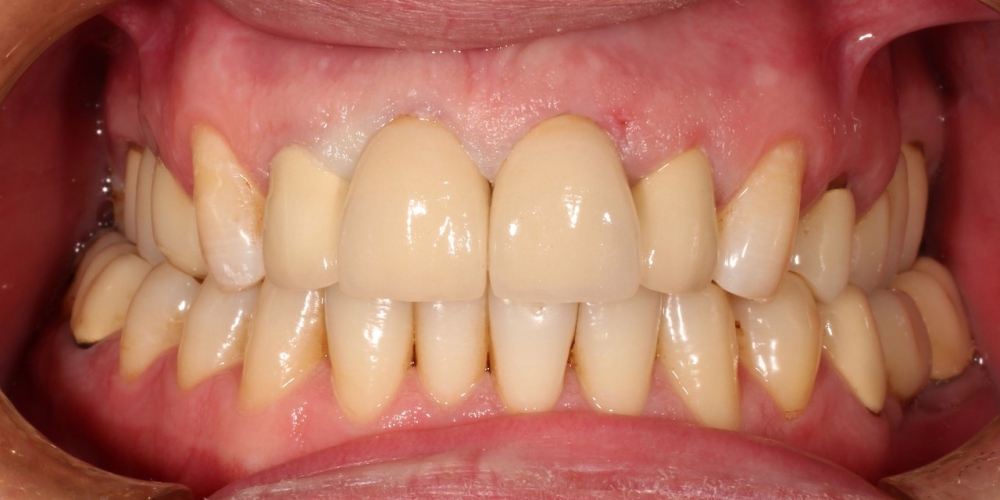 Протезирование передних зубов металлокерамикой - фото №2
