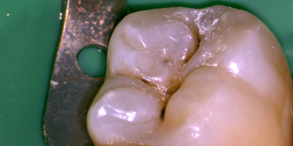 Лечение кариеса нижнего седьмого зуба - фото №1