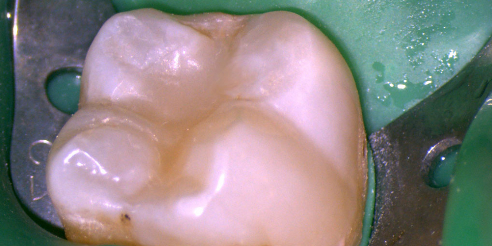 Лечение кариеса нижнего седьмого зуба - фото №4