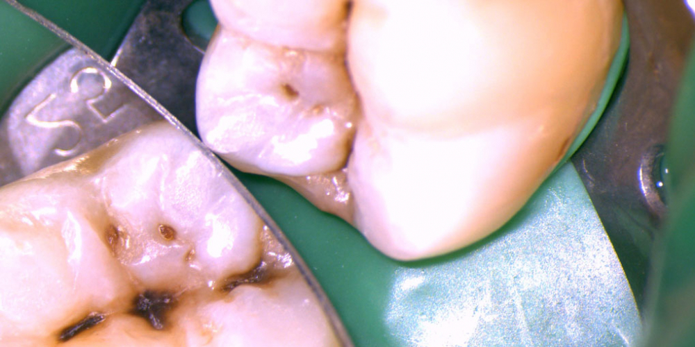 Лечение кариеса нижнего седьмого зуба - фото №3