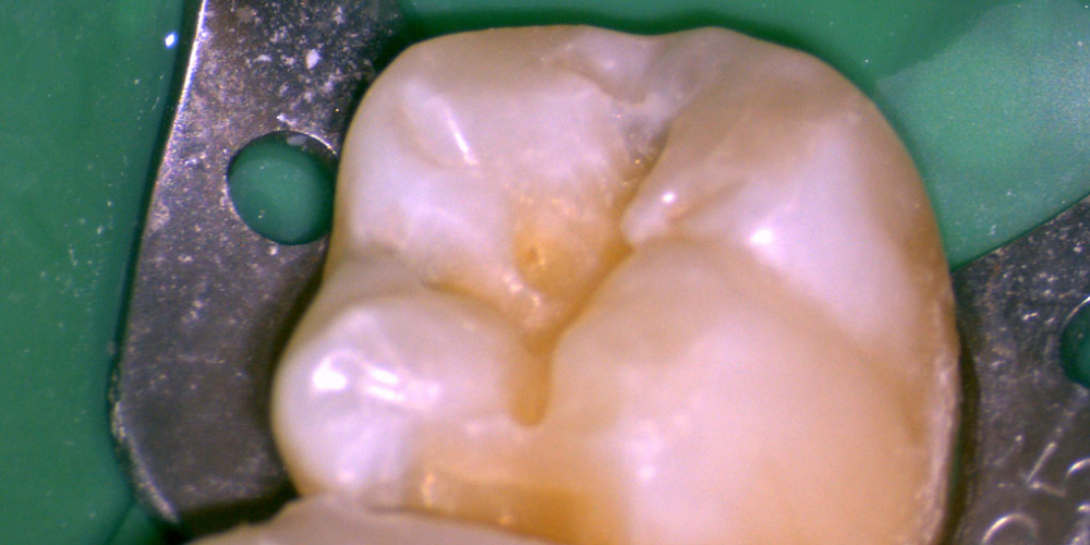 Лечение кариеса нижнего седьмого зуба - фото №2