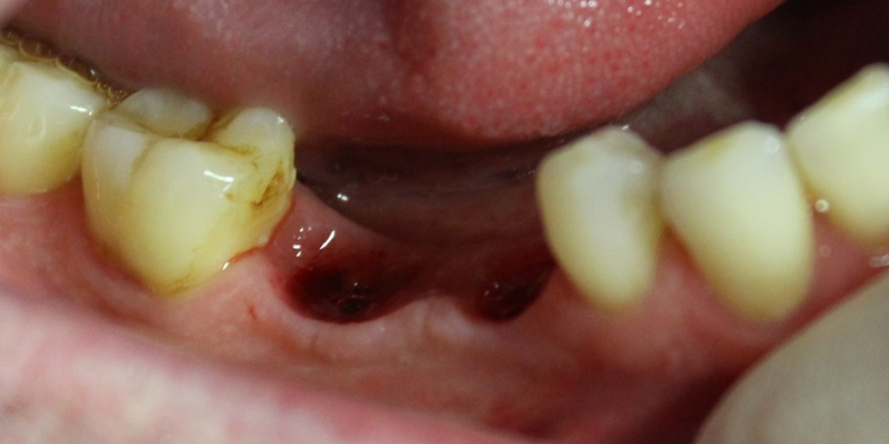 Восстановление двух отсутствующих зубов единичными коронками на диоксиде циркония - фото №1
