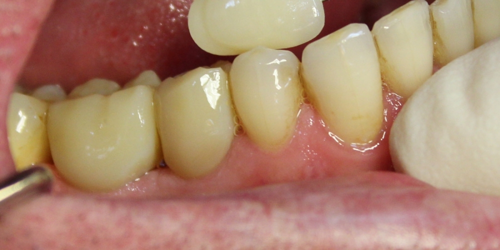 Восстановление двух отсутствующих зубов единичными коронками на диоксиде циркония - фото №2