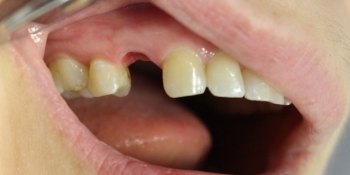 Восстановление зуба коронкой на имплантате - фото №1