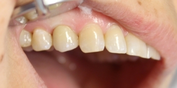 Восстановление зуба коронкой на имплантате - фото №4