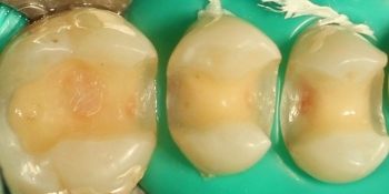 Восстановление жевательных верхних правых зубов композитными вкладками - фото №1