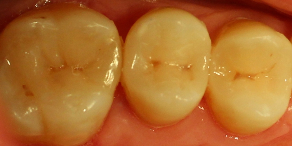 Восстановление жевательных верхних правых зубов композитными вкладками - фото №2
