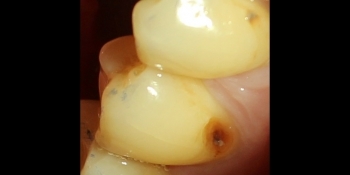 Устранение пришеечного кариеса второго нижнего малого жевательного зуба пломбой - фото №1