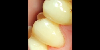 Устранение пришеечного кариеса второго нижнего малого жевательного зуба пломбой - фото №2