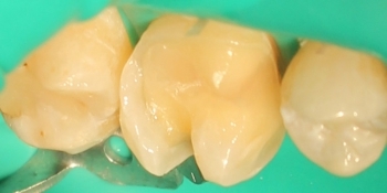 Восстановление зуба композитной вкладкой - фото №1