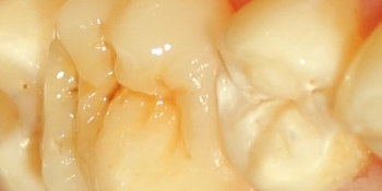 Восстановление зуба композитной вкладкой - фото №2