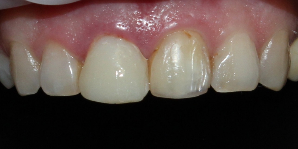 Безметалловые коронки, виниры фронтальной группы зубов - фото №1