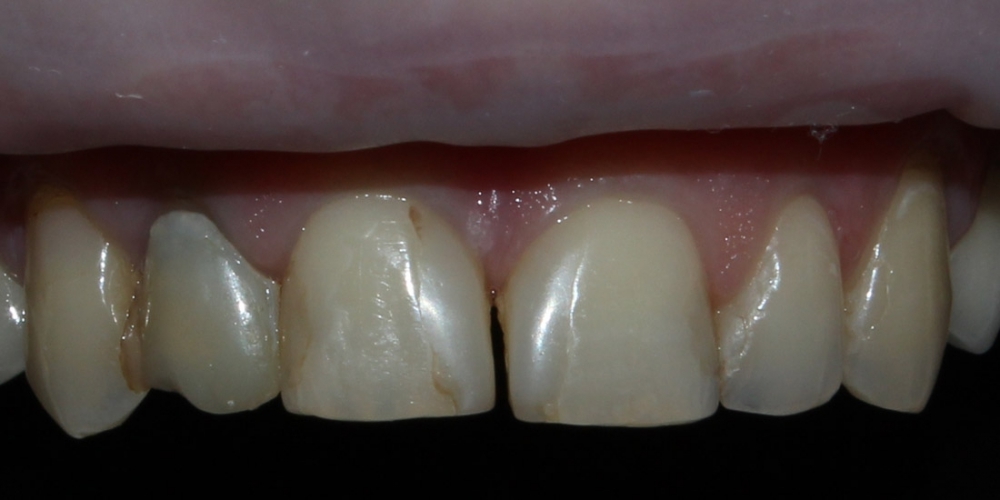 Безметалловые коронки, виниры фронтальной группы зубов - фото №1