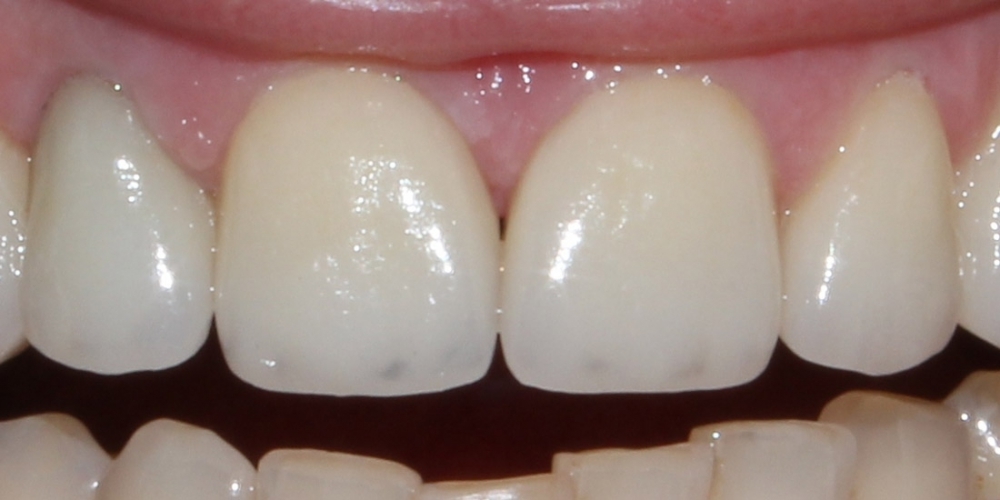 Безметалловые коронки, виниры фронтальной группы зубов - фото №2