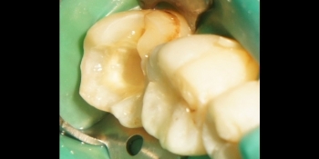 Восстановление второго нижнего жевательного зуба слева композитной вкладкой - фото №1