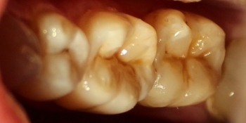 Восстановление второго нижнего жевательного зуба слева композитной вкладкой - фото №6
