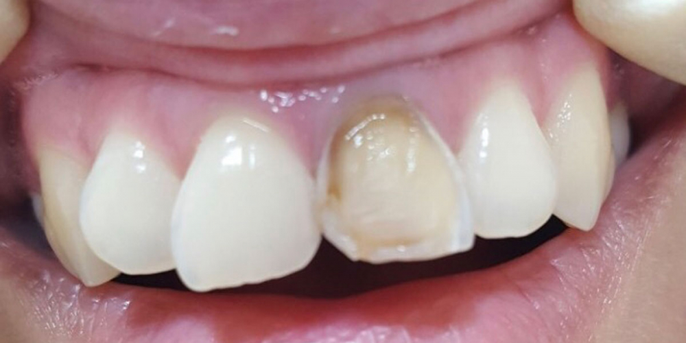 Косметическая (художественная) реставрация фронтального зуба методом прямого винирования - фото №1