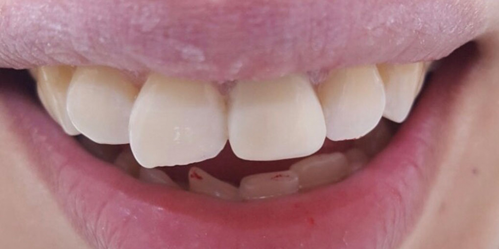 Косметическая (художественная) реставрация фронтального зуба методом прямого винирования - фото №2