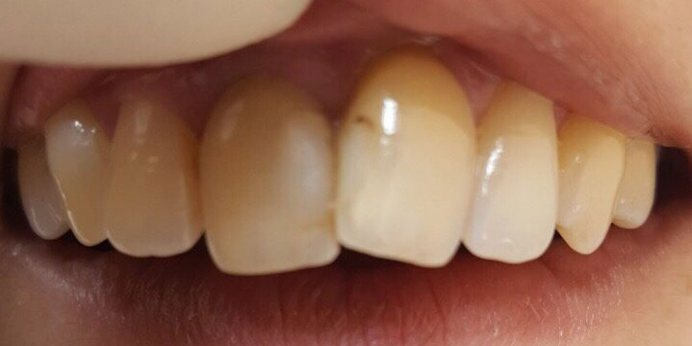 Реставрация фронтальных зубов методом прямого винирования - фото №1