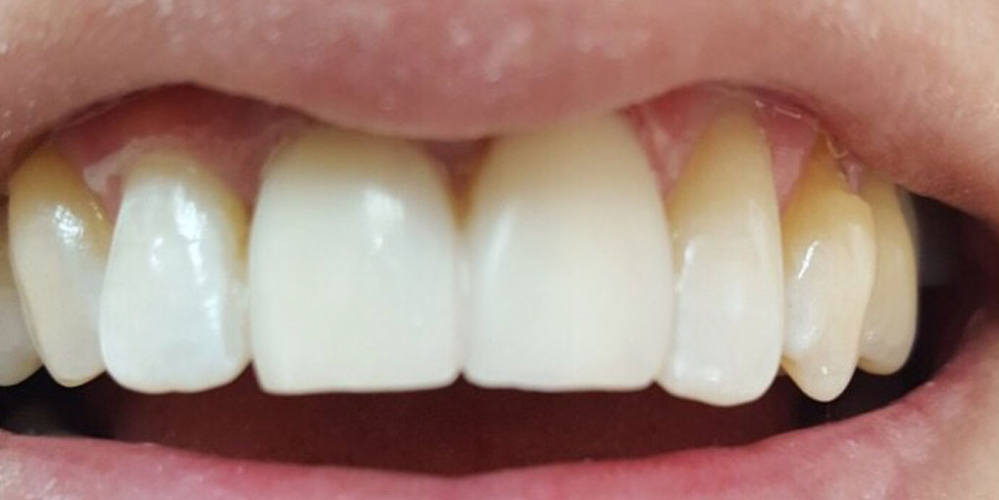 Реставрация фронтальных зубов методом прямого винирования - фото №2