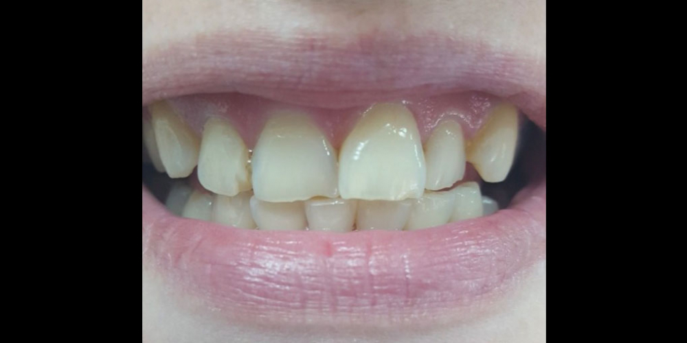Косметическая (художественная) реставрация 2-х центральных зубов - фото №1