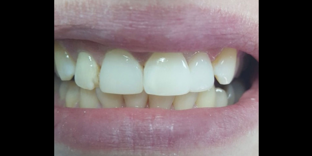 Косметическая (художественная) реставрация 2-х центральных зубов - фото №2