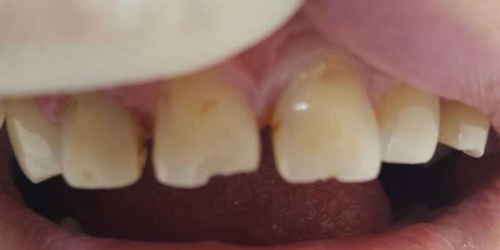 Устранение сколов и диастемы между передними зубами композитными материалами - фото №1