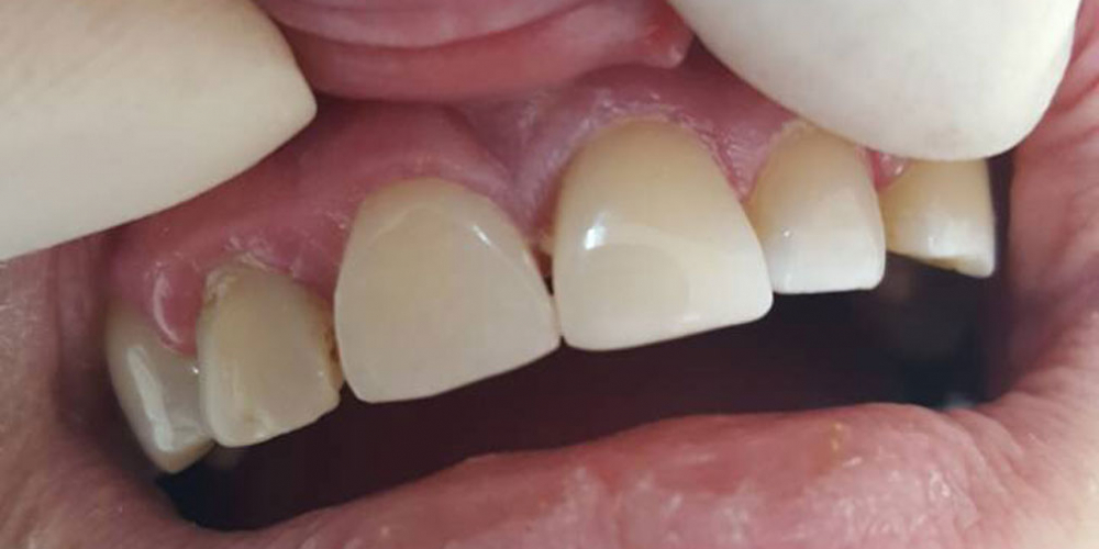Устранение сколов и диастемы между передними зубами композитными материалами - фото №2