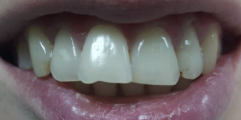 Неправильное расположение фронтальных зубов, сколов и изъявлений на режущих краях - фото №1