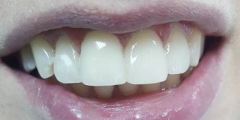 Неправильное расположение фронтальных зубов, сколов и изъявлений на режущих краях - фото №2