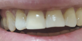 Косметическая (художественная) реставрация зуба - фото №2