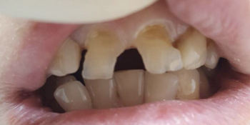 Исправление дефектов передних зубов без протезирования - фото №1