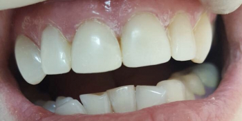 Исправление дефектов передних зубов без протезирования - фото №2